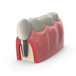 implantes dentales en bogotá